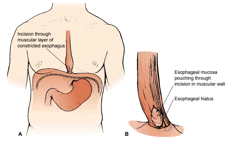 Achalasia - Disorders of the Esophagus