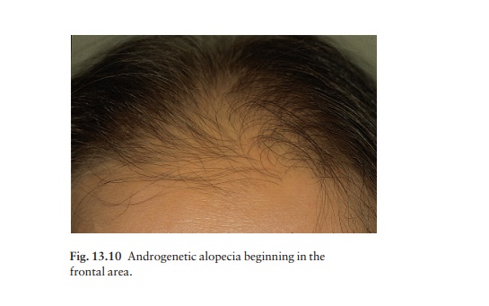 Androgenetic alopecia (male-pattern baldness)