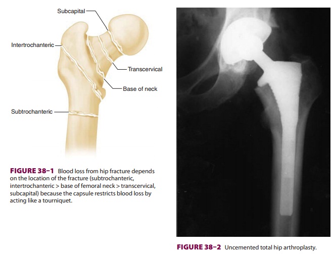Anesthesia for Fracture of the Hip