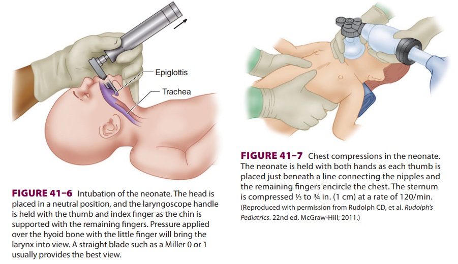 Anesthesia for Neonatal Resuscitation