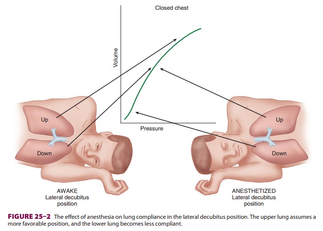 Anesthesia for Thoracic Surgery: The Lateral Decubitus Position