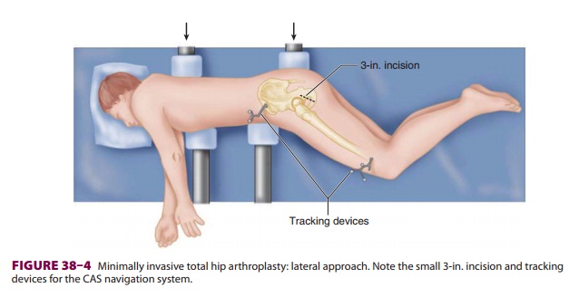 Anesthesia for Total Hip Arthroplasty