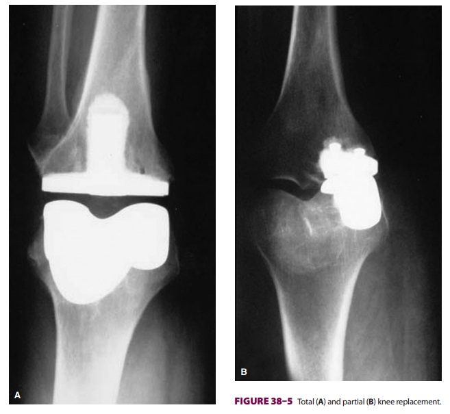 Anesthesia for Total Knee Replacement
