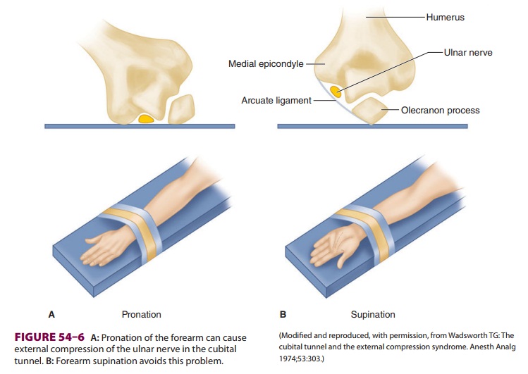 Anesthetic Complications: Peripheral Nerve Injury