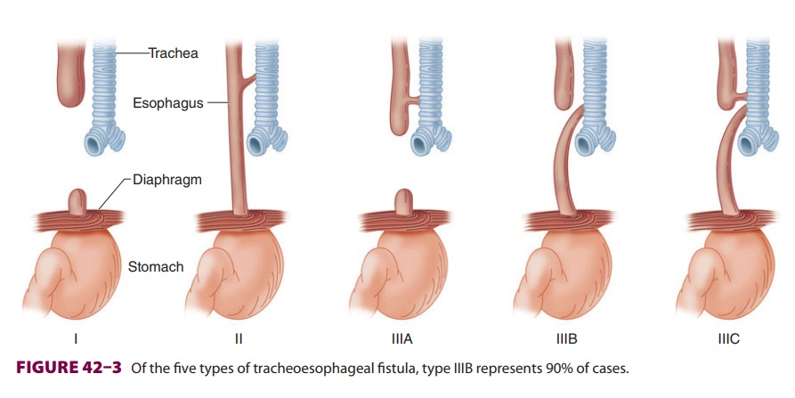 Anesthetic Considerations in Tracheoesophageal Fistula