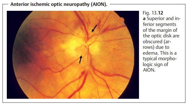 Arteriosclerotic Anterior Ischemic Optic Neuropathy