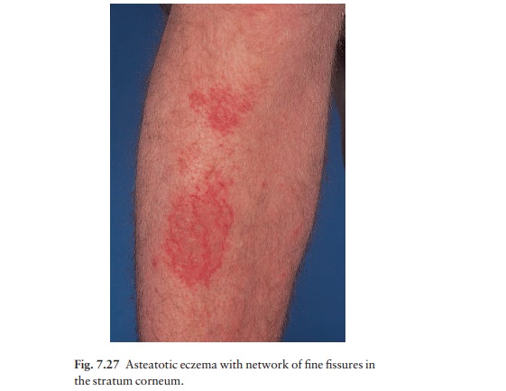 Asteatotic eczema