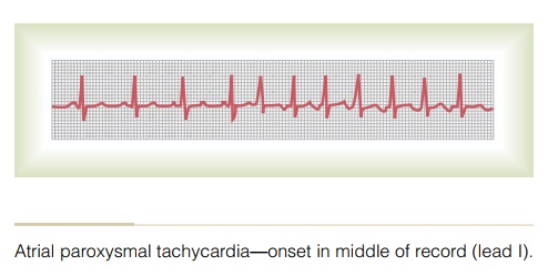 Atrial Paroxysmal Tachycardia