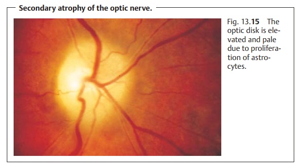 Atrophy of the Optic Nerve