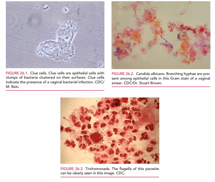 Bacterial Vaginosis (BV): Vulvovaginal Candidiasis, Trichomonas Vulvovaginitis