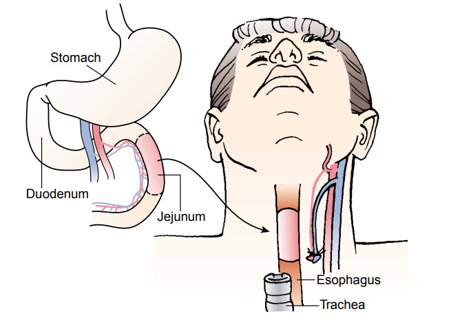 Benign Tumors and Cancer of the Esophagus