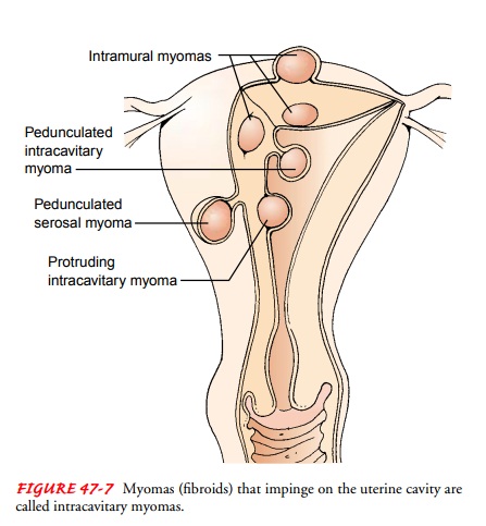 Benign Tumors of the Uterus:Fibroids (Leiomyomas, Myomas)