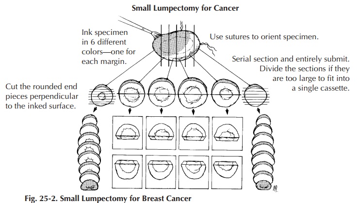 Breast Lumpectomy : Surgical Pathology Dissection