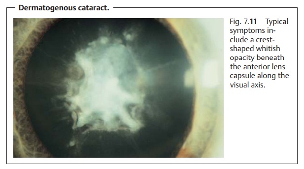 Cataract in Systemic Disease