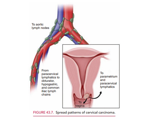 Cervical Carcinoma