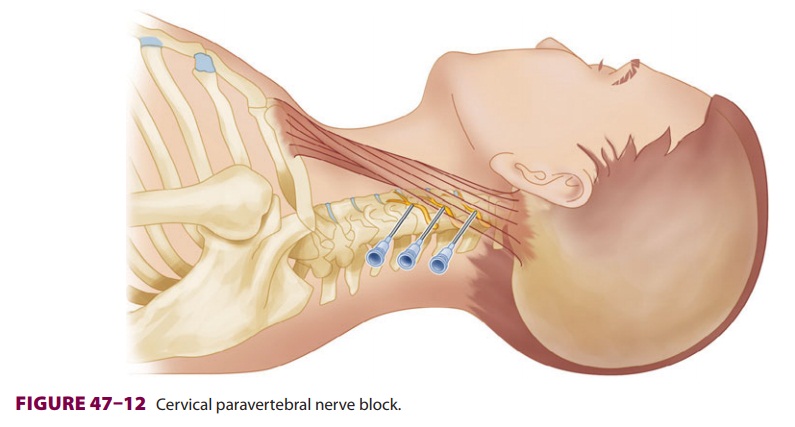 Cervical Paravertebral Nerve Blocks