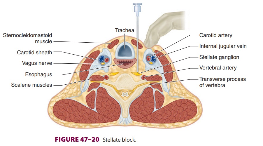 Cervicothoracic (Stellate) Block