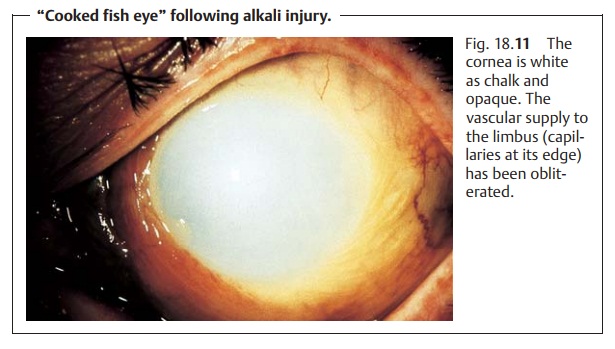 Chemical Injuries in Eye