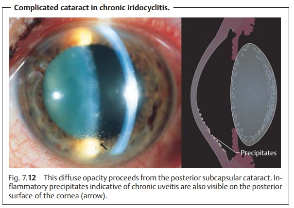 Complicated Cataracts