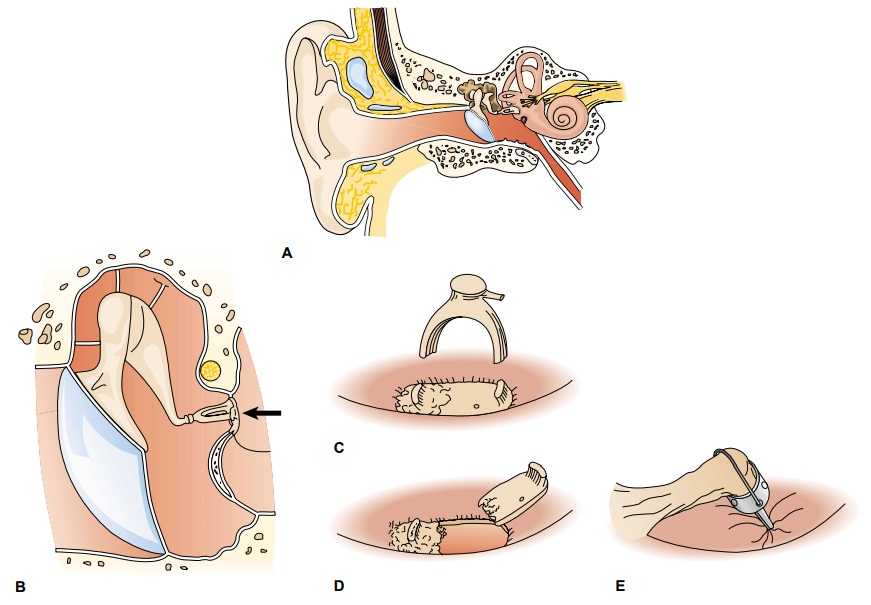 Conditions of the Middle Ear