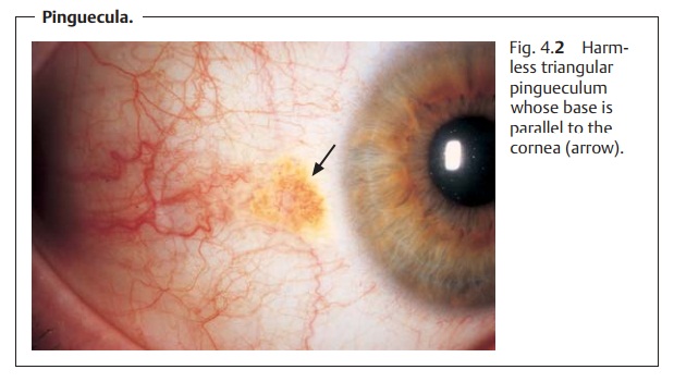 Conjunctival Degeneration and Aging Changes
