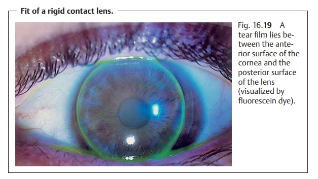 Contact Lenses - Correction of Refractive Errors