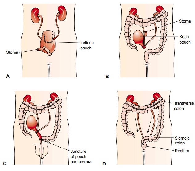Continent Urinary Diversions