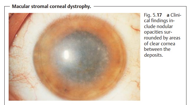 Corneal Dystrophies
