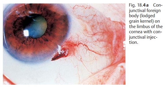 Corneal and Conjunctival Foreign Bodies