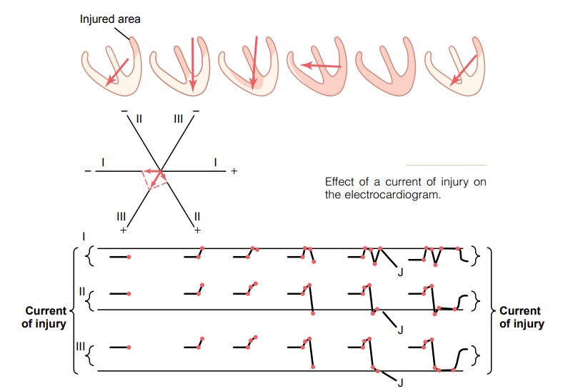 Current of Injury - Electrocardiographic Interpretation of Cardiac