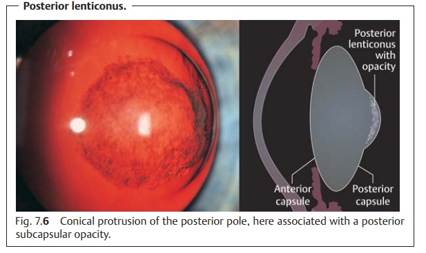 Developmental Anomalies of the Eye Lens