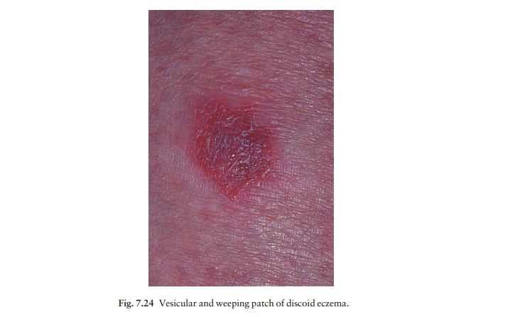 Discoid (nummular) eczema