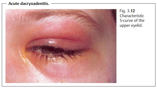 Disorders of the Lacrimal Gland