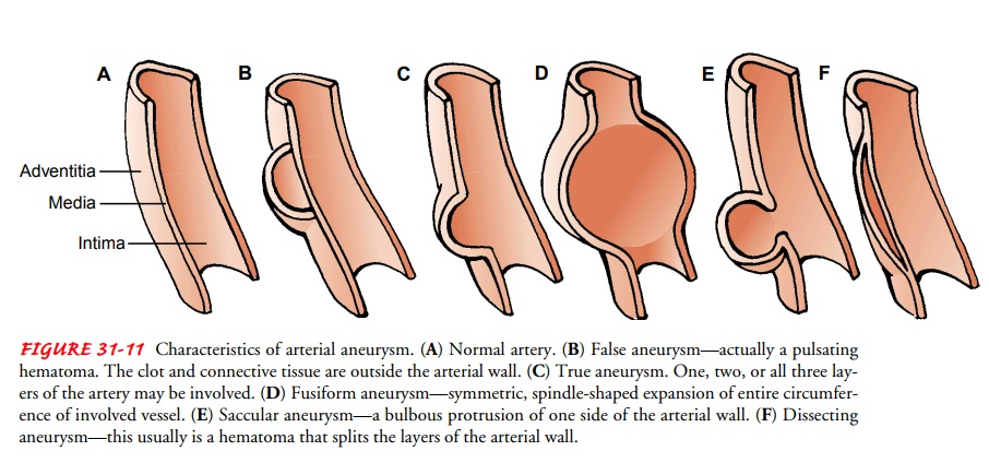 Dissecting Aorta