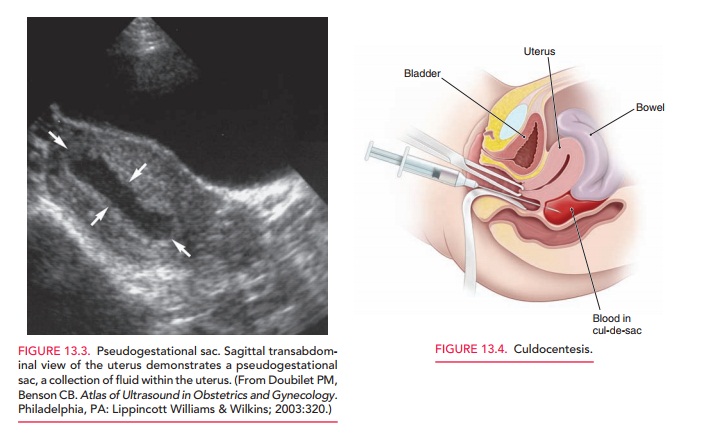Tubal Ectopic Pregnancy: Differential Diagnosis and Procedures
