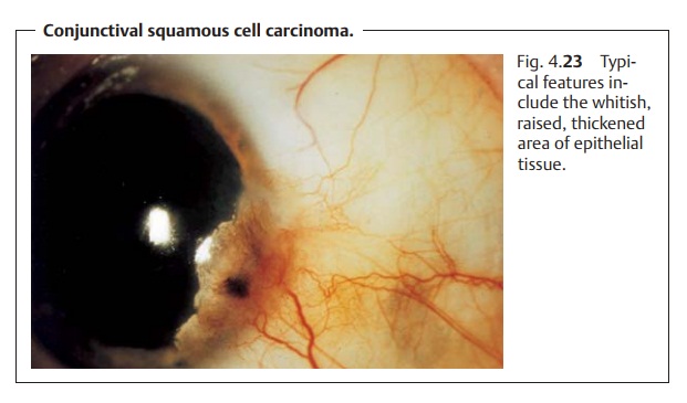 Epithelial Conjunctival Tumors