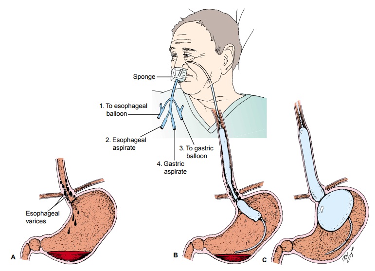 Esophageal Varices - Hepatic Dysfunction
