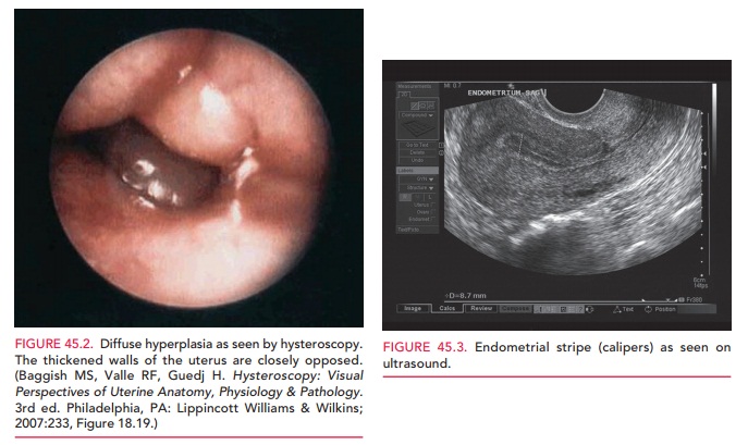 Evaluation - Endometrial Hyperplasia