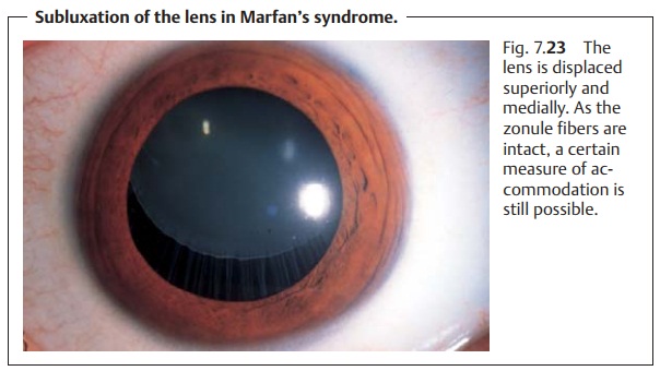 Eye Lens Dislocation