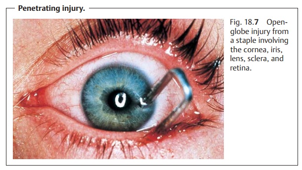 Eye Open-Globe Injuries