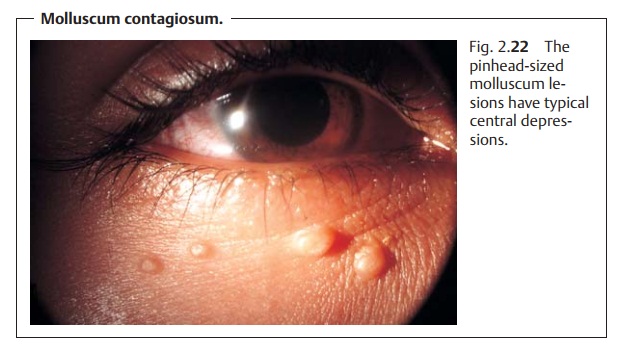 Eyelids: Benign Tumors