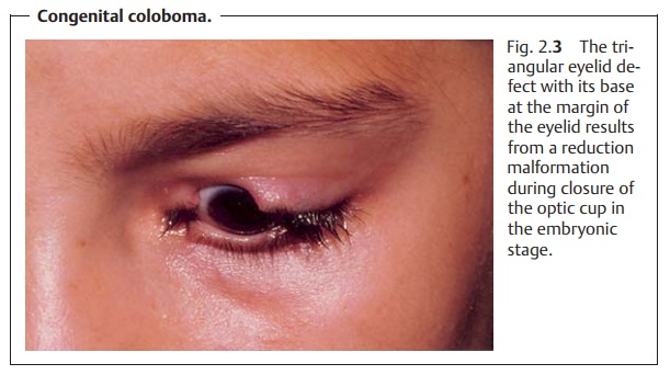 Eyelids: Developmental Anomalies