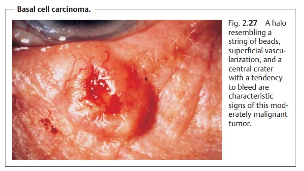 Eyelids: Malignant Tumors