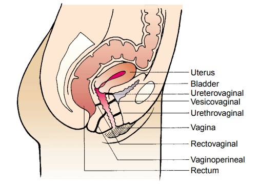 Fistulas of the Vagina - Structural Disorders