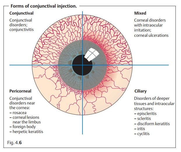 General Notes on the Causes, Symptoms, and Diagnosis of Conjunctivitis