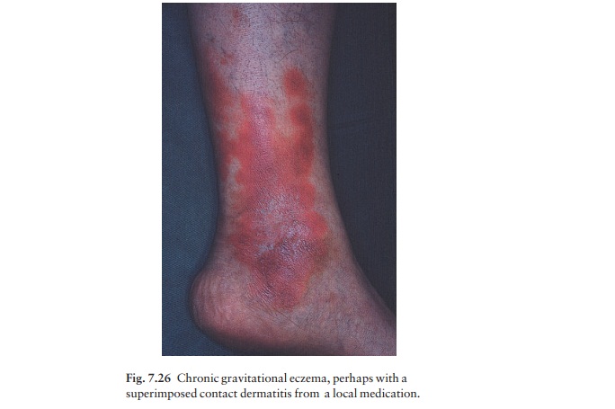 Gravitational (stasis) eczema