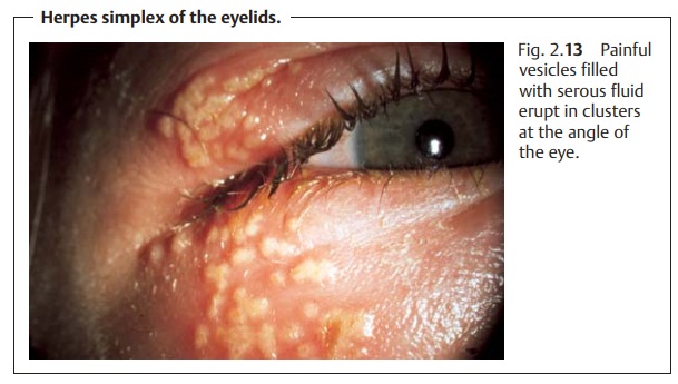 Herpes Simplex of the Eyelids