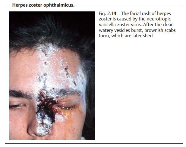 Herpes Zoster Ophthalmicus