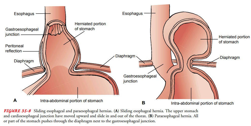 Hiatal Hernia - Disorders of the Esophagus