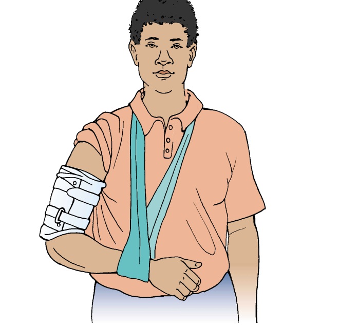 Humeral Shaft - Fracture